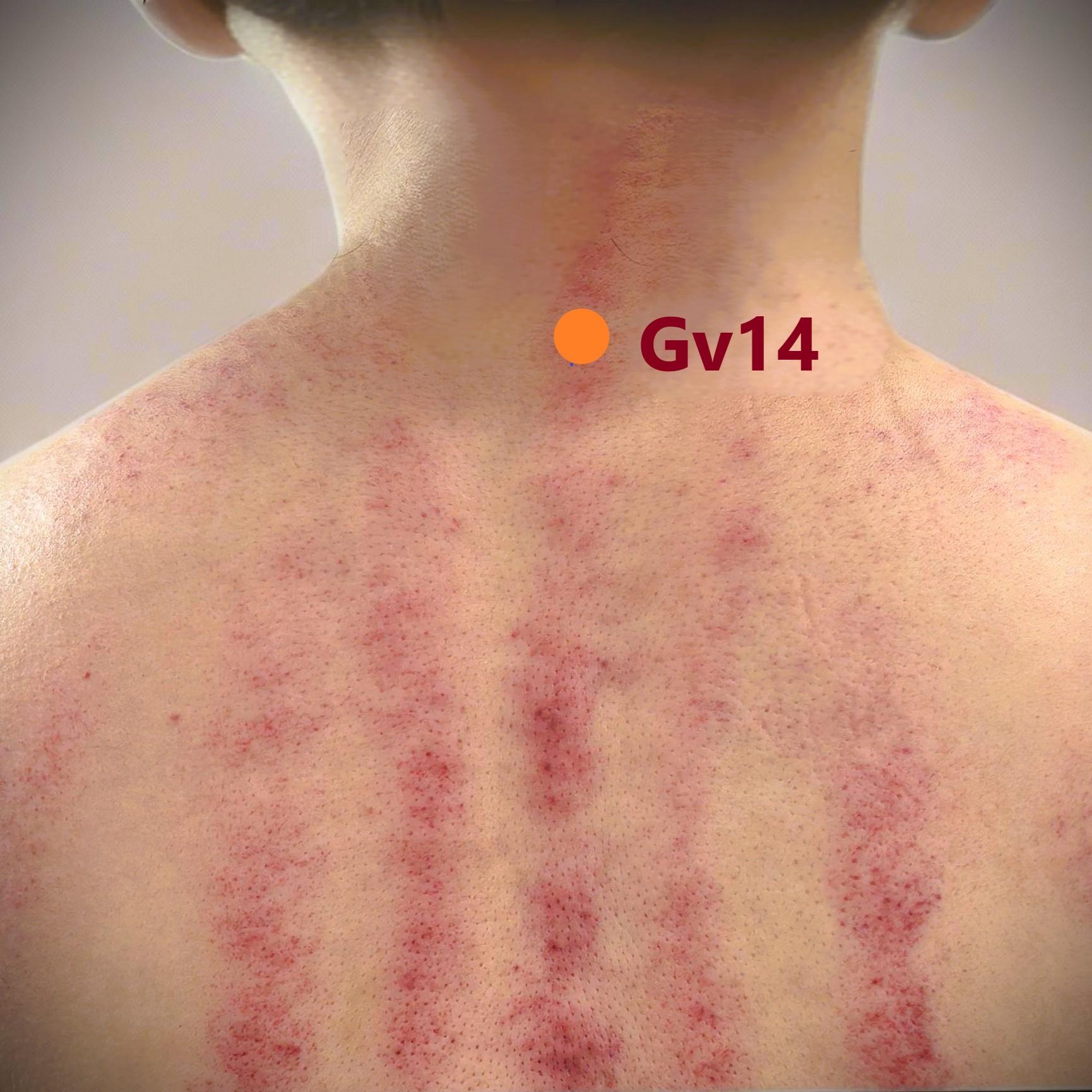 Purplish marks after scraping therapy Purplish marks after scraping therapy